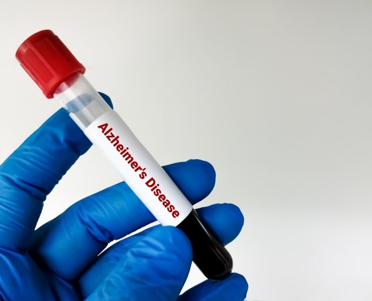 Alzheimer’s Testing Cumberland Maryland