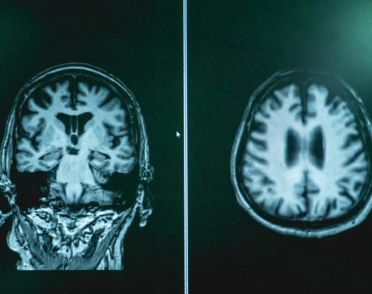 How Alzheimer’s Diagnostic Testing and Early Detection in Hagerstown, Maryland Strengthens Families