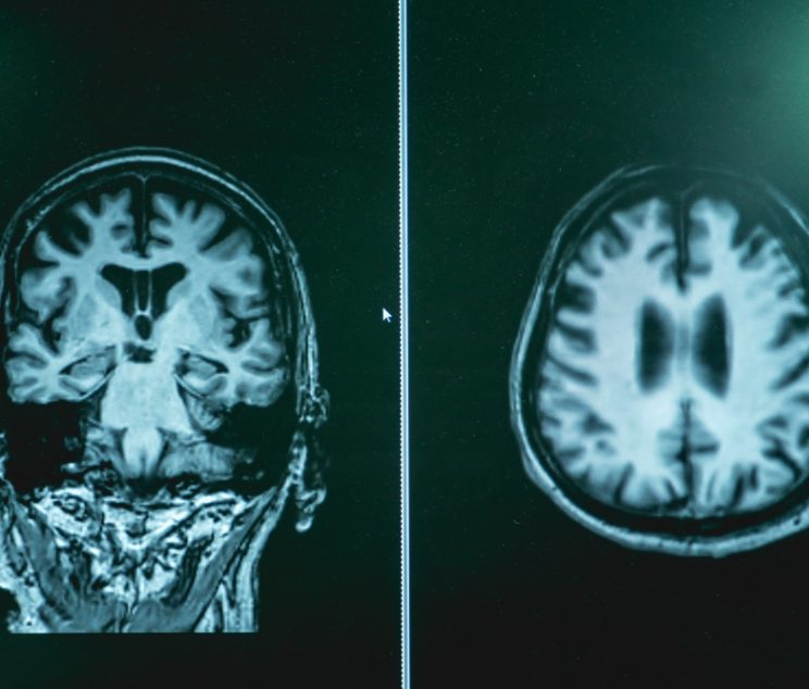 How Alzheimer’s Diagnostic Testing and Early Detection in Hagerstown, Maryland Strengthens Families