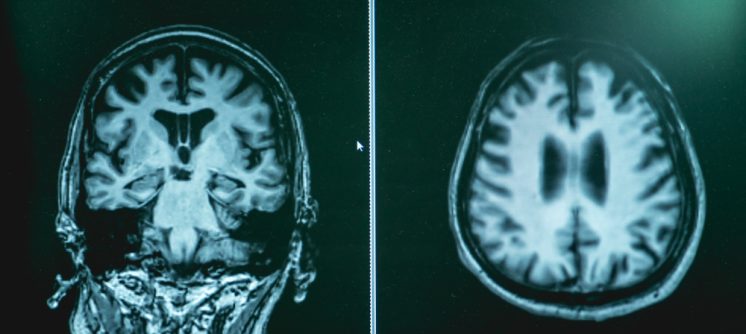 How Alzheimer’s Diagnostic Testing and Early Detection in Hagerstown, Maryland Strengthens Families