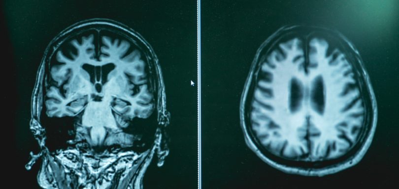 How Alzheimer’s Diagnostic Testing and Early Detection in Hagerstown, Maryland Strengthens Families