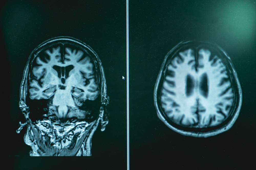 How Alzheimer’s Diagnostic Testing and Early Detection in Hagerstown, Maryland Strengthens Families