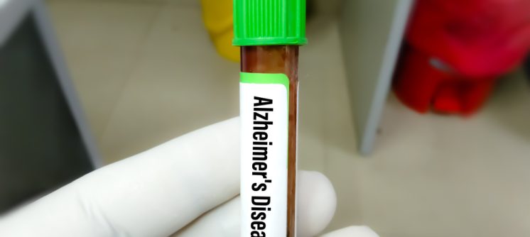 Here’s Where to Get an Amyloid PET Scan Near Me in Maryland