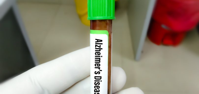 Here’s Where to Get an Amyloid PET Scan Near Me in Maryland