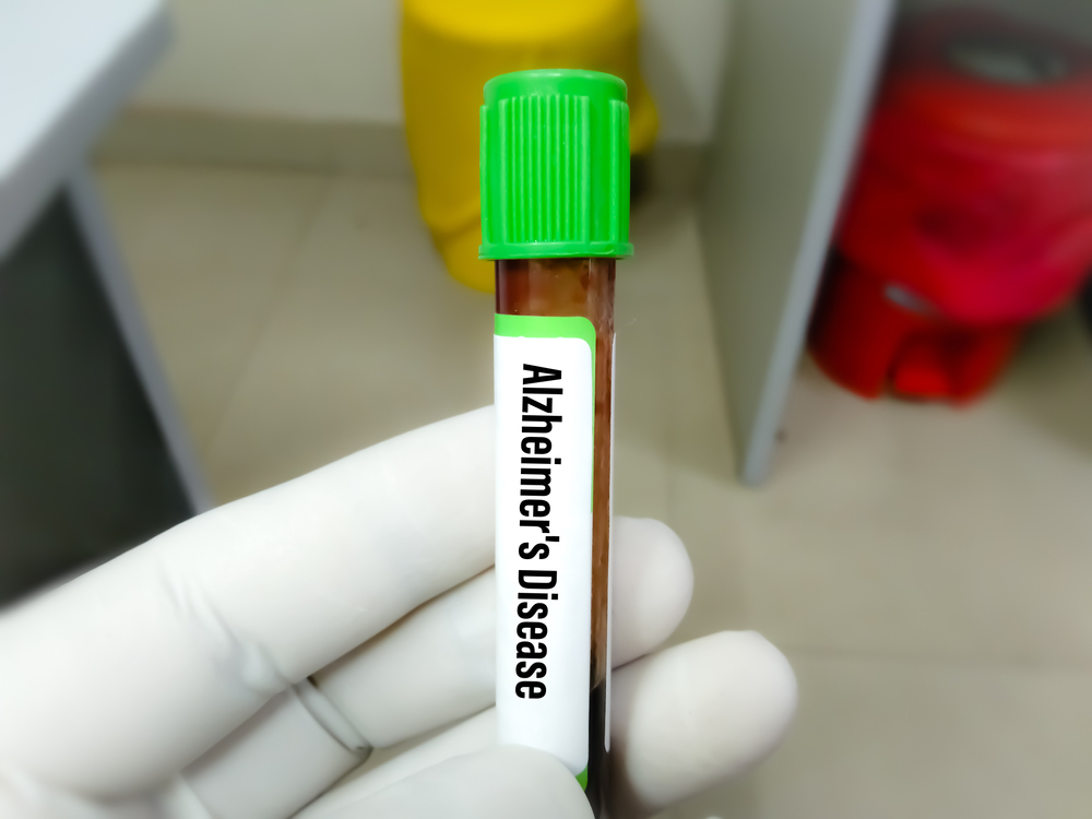 Here’s Where to Get an Amyloid PET Scan Near Me in Maryland