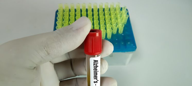 Schedule an Amyloid PET Scan for Alzheimer’s Near Cumberland, MD: Early Detection Matters