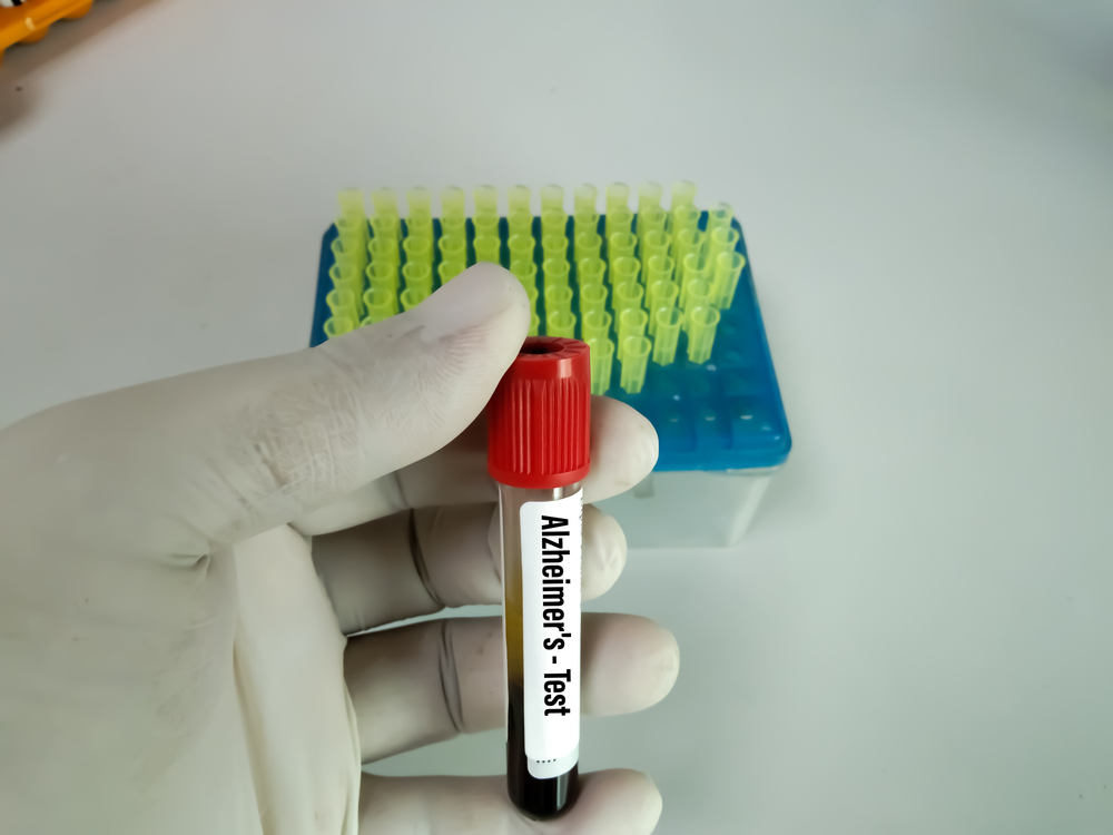 Schedule an Amyloid PET Scan for Alzheimer’s Near Cumberland, MD: Early Detection Matters