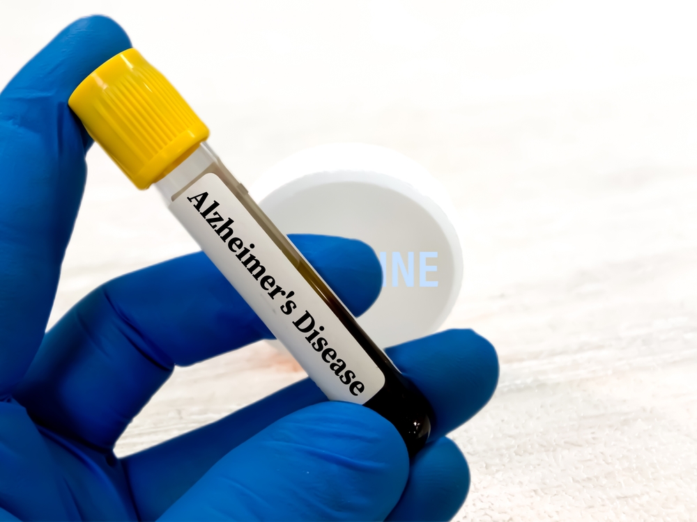 Alzheimer’s Amyloid PET Scan Imaging Services in Hagerstown MD