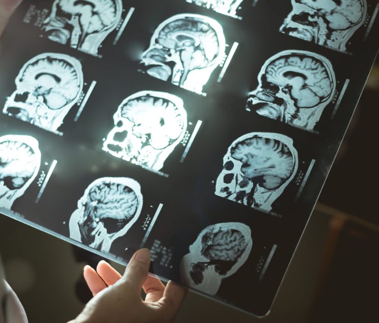 Amyloid Brain Scan Appointments for Alzheimer’s Detection in Cumberland, MD: Why Early Imaging Matters