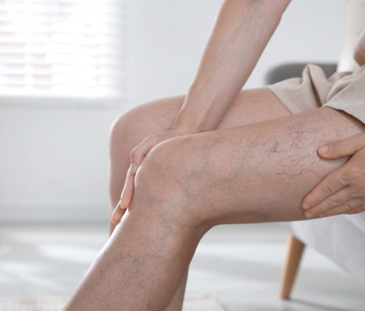 EVLT Varicose Vein Treatment With Insurance Coverage Near Cumberland Can Improve Comfort and Confidence