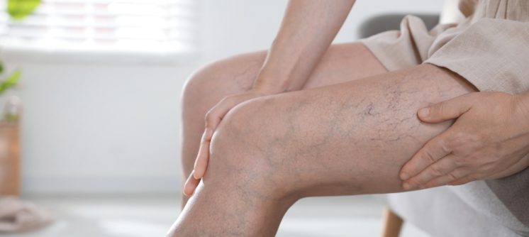 EVLT Varicose Vein Treatment With Insurance Coverage Near Cumberland Can Improve Comfort and Confidence