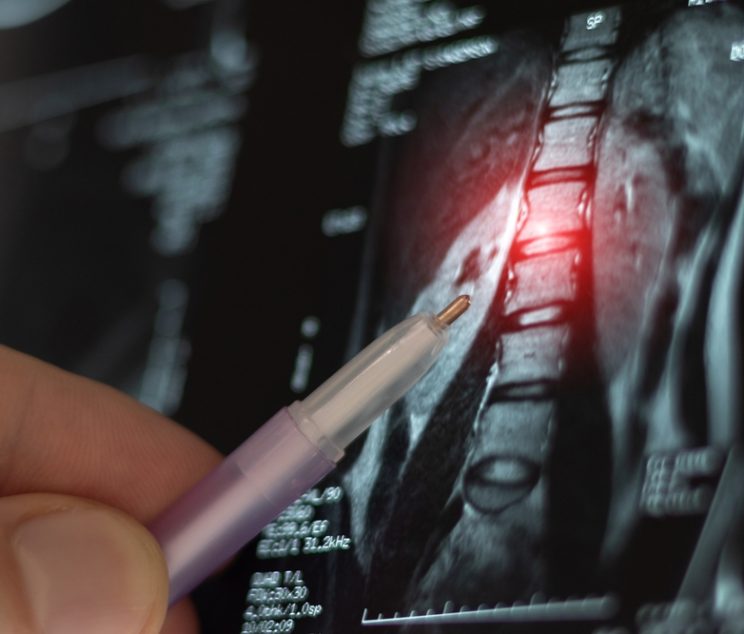 Do You Need to Prep for a Spine MRI for Back and Neck Pain Near Chambersburg, Pennsylvania?