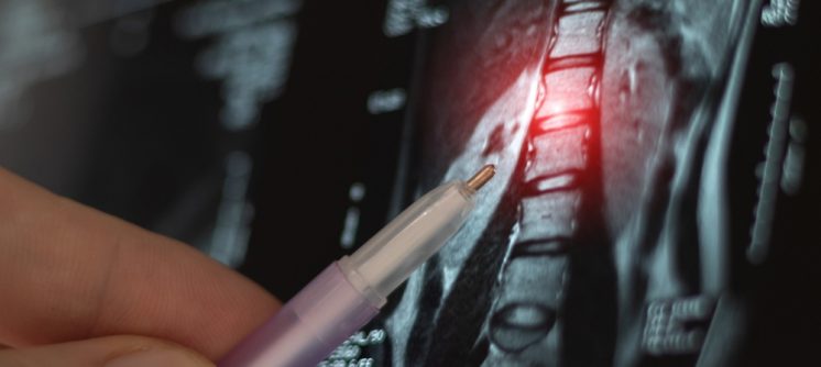 Do You Need to Prep for a Spine MRI for Back and Neck Pain Near Chambersburg, Pennsylvania?
