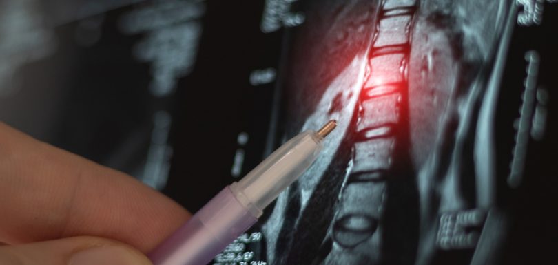 Do You Need to Prep for a Spine MRI for Back and Neck Pain Near Chambersburg, Pennsylvania?