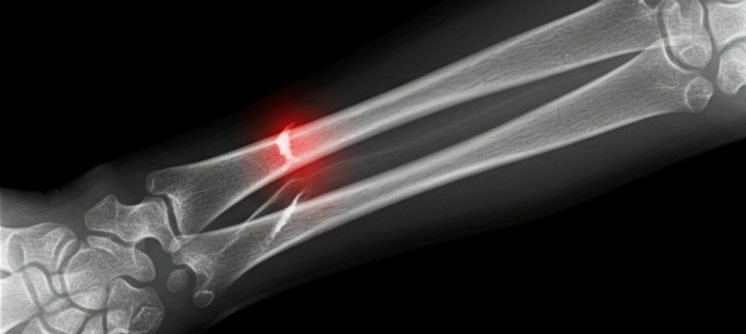 X-Ray For Broken Arm Near Winchester, VA: Same Day Imaging