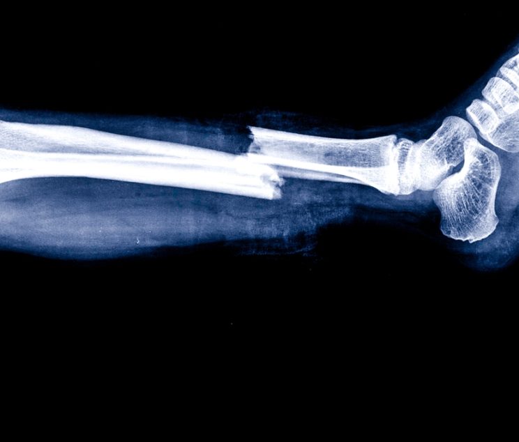X-Ray Imaging Center Near Frederick, MD For Broken Bones And Sprains