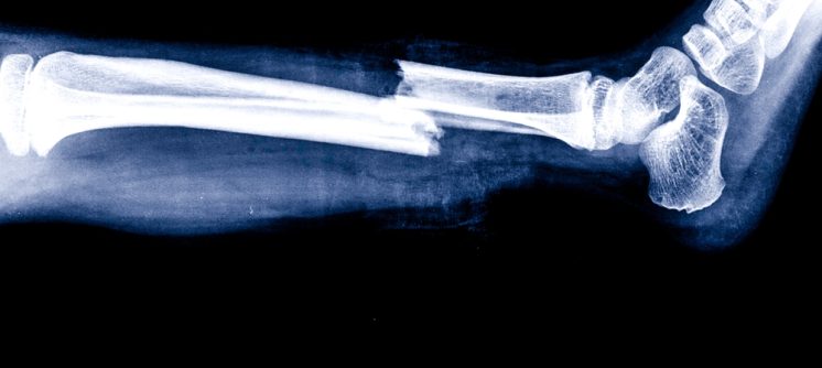 X-Ray Imaging Center Near Frederick, MD For Broken Bones And Sprains