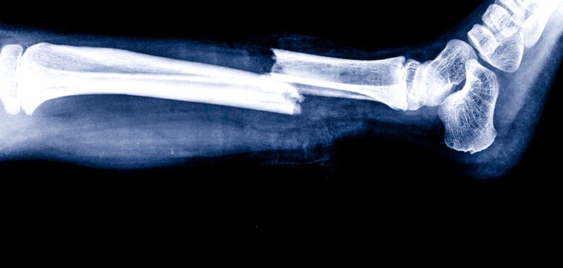 X-Ray Imaging Center Near Frederick, MD For Broken Bones And Sprains