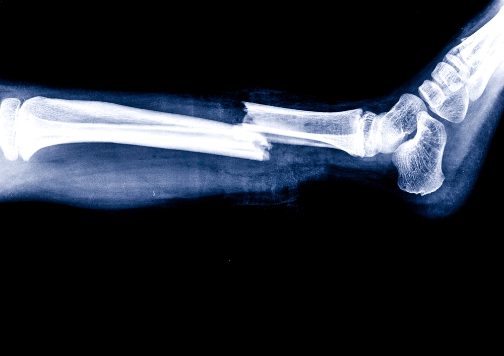 X-Ray Imaging Center Near Frederick, MD For Broken Bones And Sprains