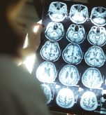 Amyloid Brain Scan Near Leesburg, VA For Early Alzheimer’s Detection