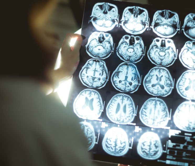 Amyloid Brain Scan Near Leesburg, VA For Early Alzheimer’s Detection