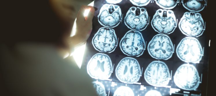 Amyloid Brain Scan Near Leesburg, VA For Early Alzheimer’s Detection