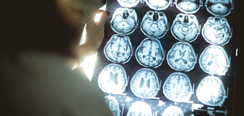 Amyloid Brain Scan Near Leesburg, VA For Early Alzheimer’s Detection